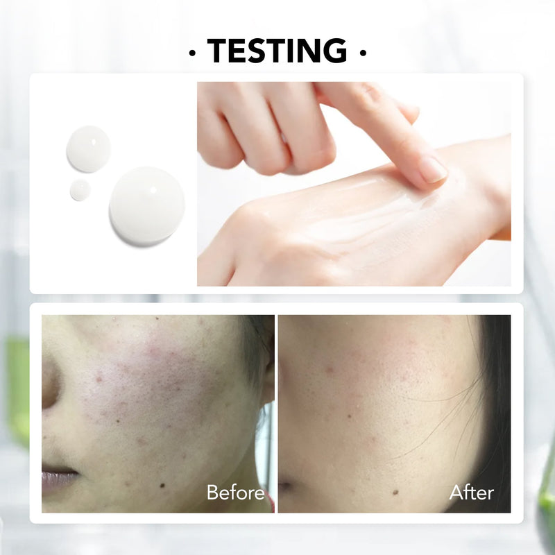 AcnePlus Complete Solution Serum